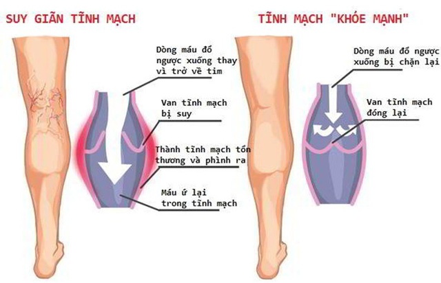 Suy tĩnh mạch - Ảnh minh họa 2