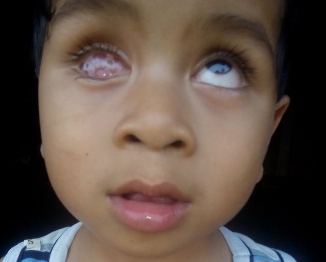 Retinoblastoma - Ảnh minh họa 4