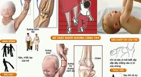 Sai khớp - Ảnh minh họa 2