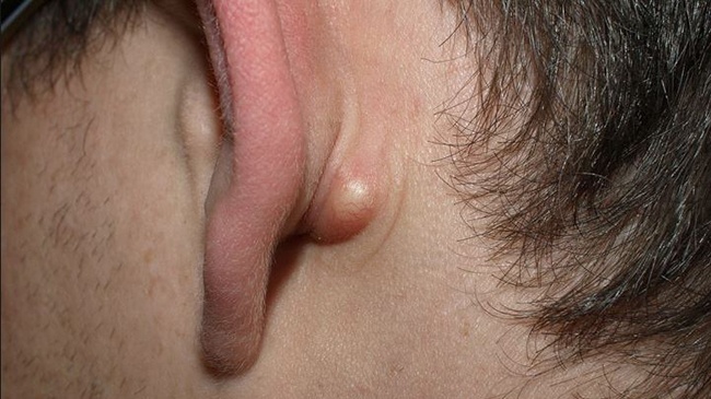 Sebaceous cyst - Ảnh minh họa 1