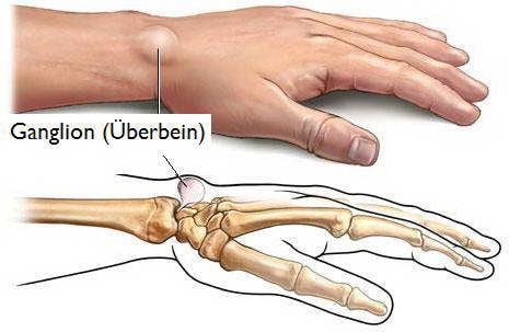 Synovial Cyst - Ảnh minh họa 5