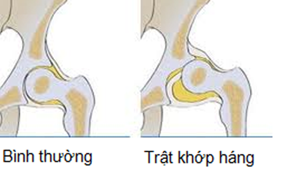 Sai khớp - Ảnh minh họa 4