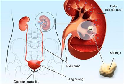 Sỏi tiết niệu - Ảnh minh họa 1