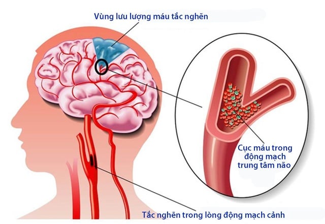 Stroke - Ảnh minh họa 2