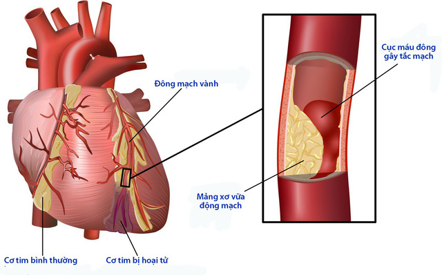 Suy mạch máu do bệnh động mạch ngoại biên - Ảnh minh họa 3