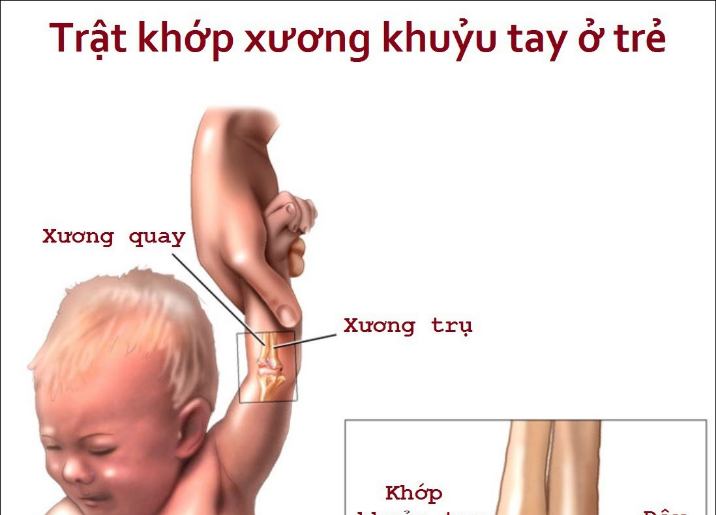 Sai khớp đầu xương quay ở trẻ em - Ảnh minh họa 4