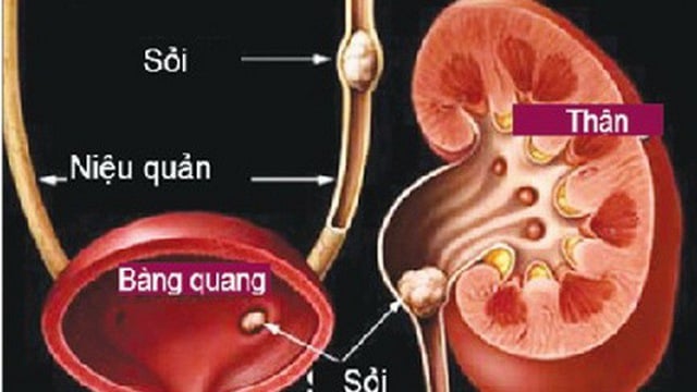 Sỏi tiết niệu - Ảnh minh họa 2