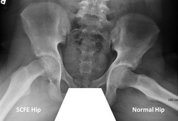 Slipped Capital Femoral Epiphysis - Ảnh minh họa 2