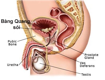 Sỏi bàng quang, tiết niệu - Ảnh minh họa 2