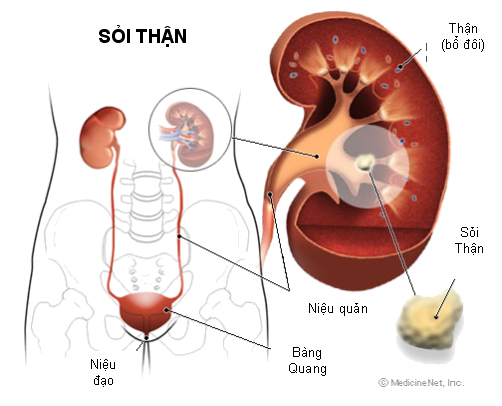 Sỏi tiết niệu - Ảnh minh họa 4