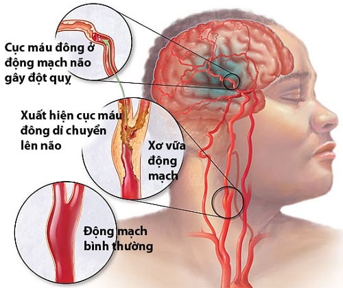 Stroke - Ảnh minh họa 1