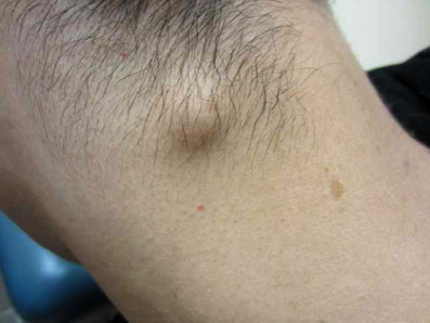 Sebaceous cyst - Ảnh minh họa 4