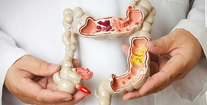 Colorectal cancers - Ảnh minh họa 2