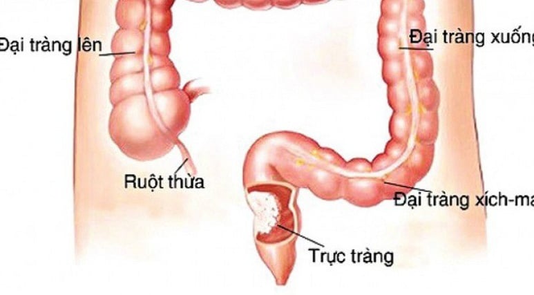 Colorectal cancers - Ảnh minh họa 3