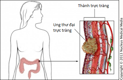 Colorectal cancers - Ảnh minh họa 4