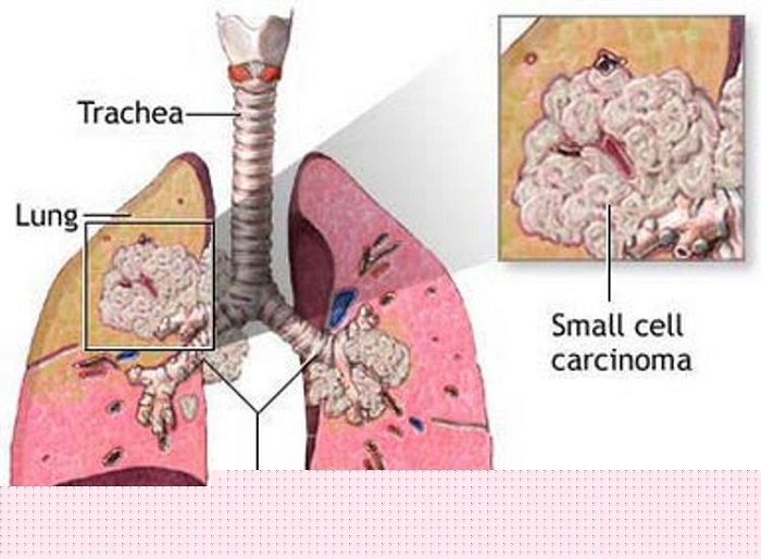 Small-cell Carcinoma - Ảnh minh họa 4