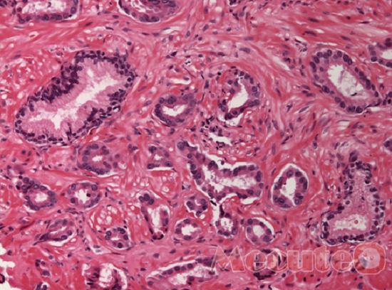 Squamous Cell Carcinoma - Ảnh minh họa 3