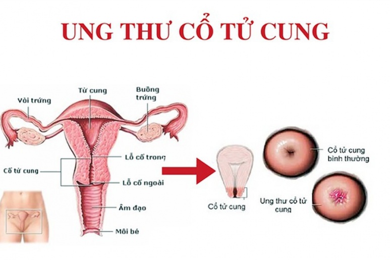 Cervical cancer - Ảnh minh họa 1