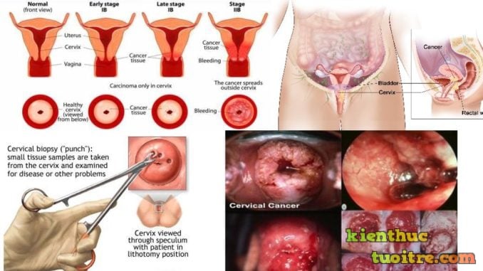 Cervical cancer - Ảnh minh họa 2