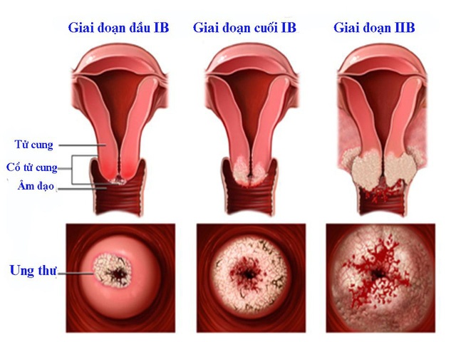 Cervical cancer - Ảnh minh họa 3