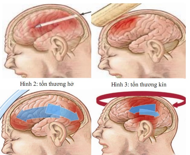 Tụ máu não - Ảnh minh họa 2