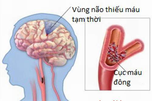 Thiểu năng động mạch đốt sống thân nền - Ảnh minh họa 4