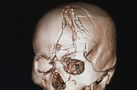 Cerebrospinal Fluid Rhinorrhea - Ảnh minh họa 1