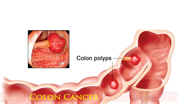 Colon cancer - Ảnh minh họa 2