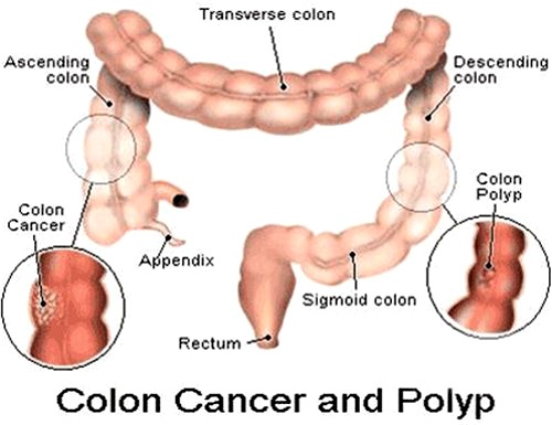 Colon cancer - Ảnh minh họa 4