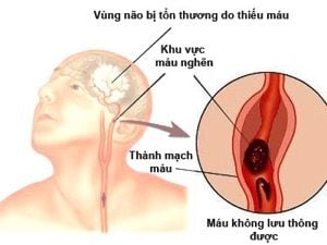 Thiểu năng động mạch đốt sống thân nền - Ảnh minh họa 1