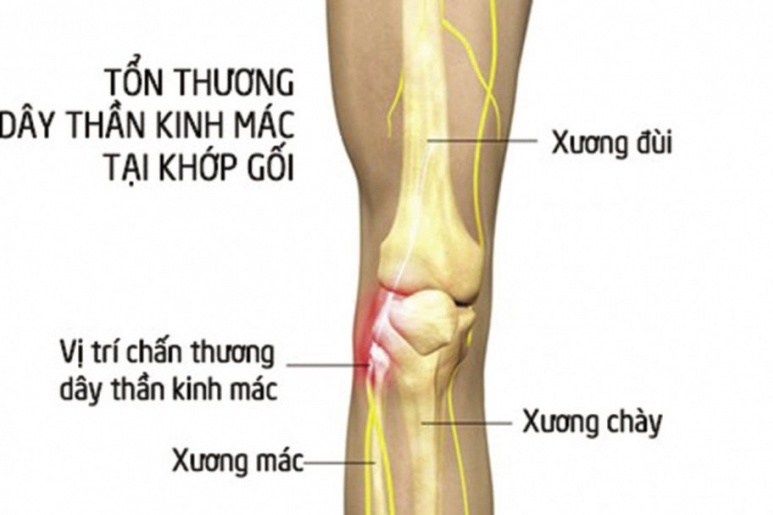 Tổn thương dây thần kinh do chấn thương - Ảnh minh họa 3