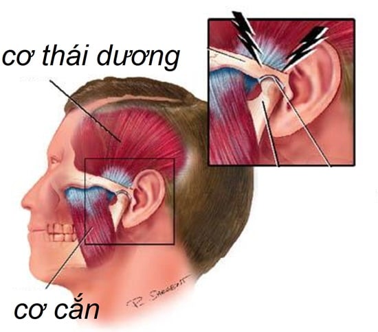 Temporal Arteritis - Ảnh minh họa 2