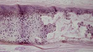 Cystic fibrosis - Ảnh minh họa 1