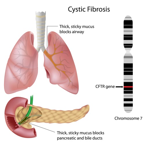 Cystic fibrosis - Ảnh minh họa 2