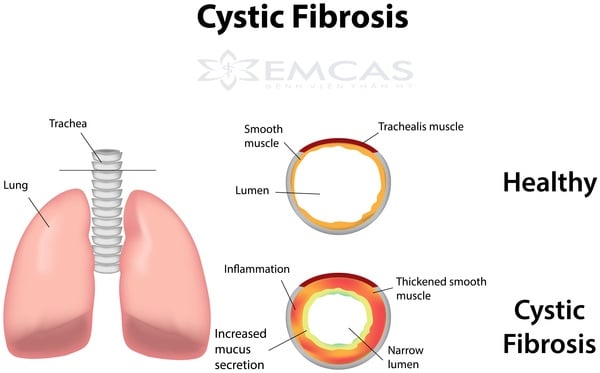 Cystic fibrosis - Ảnh minh họa 3