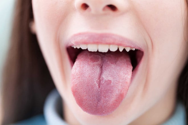 Tongue cancer - Ảnh minh họa 2