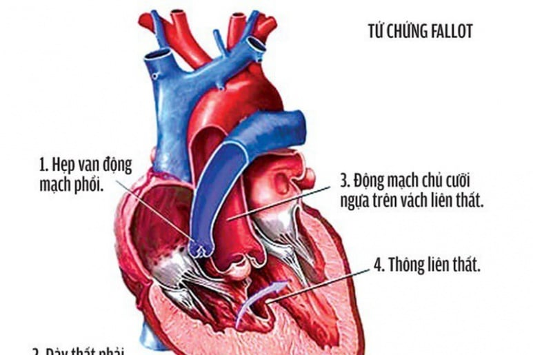 Thông liên thất - Ảnh minh họa 1