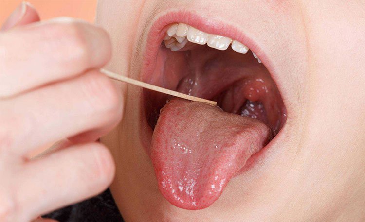 Tongue cancer - Ảnh minh họa 3