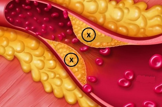 Tắc mạch máu do mỡ - Ảnh minh họa 4