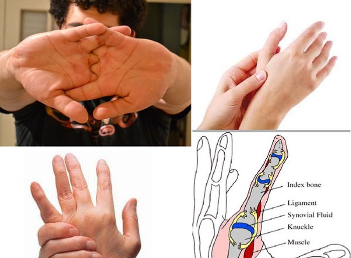Trật khớp ngón tay - Ảnh minh họa 4