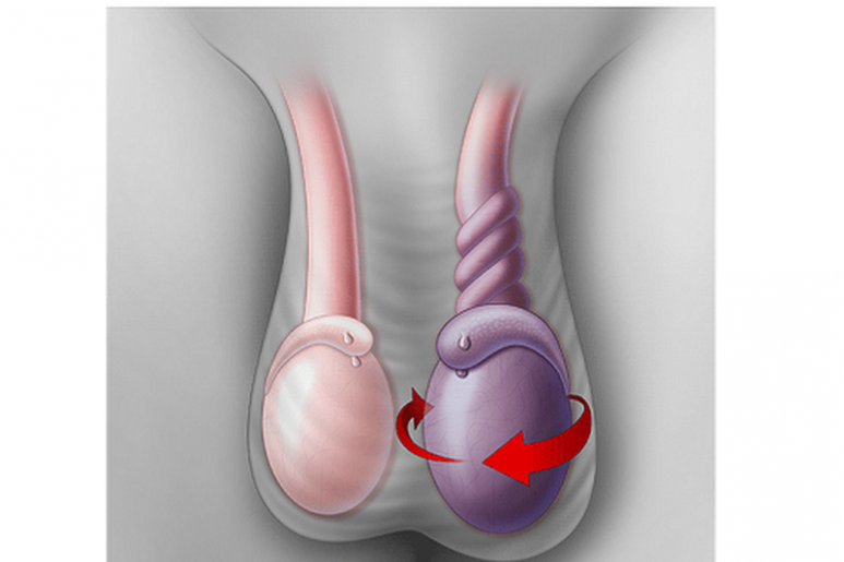 Testicular torsion - Ảnh minh họa 2