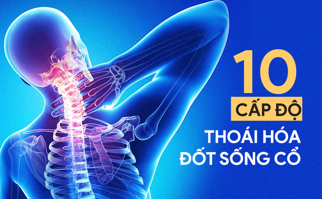 Thoái hóa đốt sống cổ - Ảnh minh họa 3