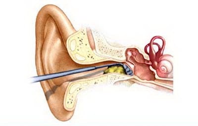 Tắc nghẽn ráy tai - Ảnh minh họa 2