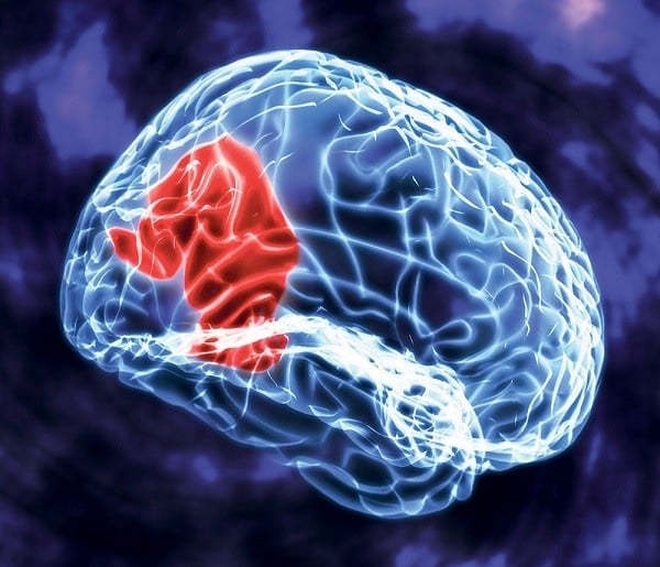 Temporal Lobe Epilepsy - Ảnh minh họa 4