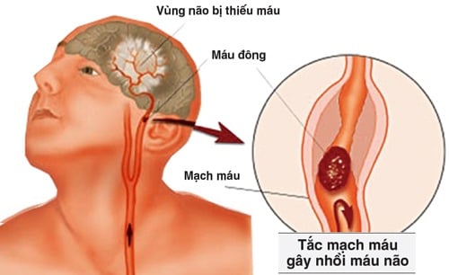 Thiểu năng động mạch đốt sống thân nền - Ảnh minh họa 2