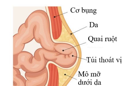 Thoát vị bẹn - Ảnh minh họa 2