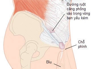 Thoát vị bẹn - Ảnh minh họa 3