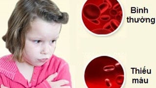 Thiếu máu beta Thalassaemia - Ảnh minh họa 3