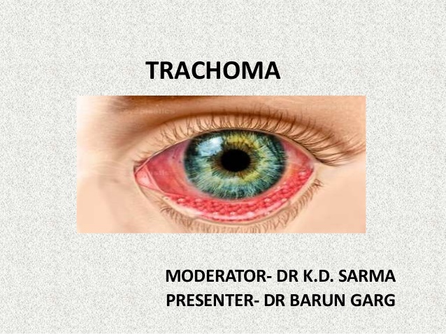 Trachoma - Ảnh minh họa 3