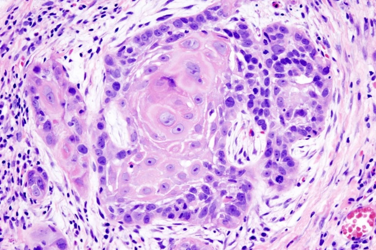 Squamous Cell Carcinoma - Ảnh minh họa 1